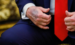 Trump’ın elindeki morluk dikkat çekti