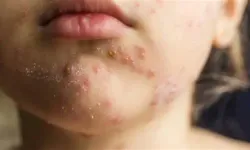 Aşı oranlarındaki düşüş kızamığı geri getirdi