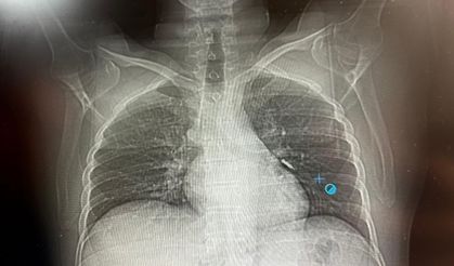İmplant vidası ciğerine kaçan hasta ölümden döndü