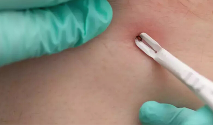 İzmir’de kene alarmı!