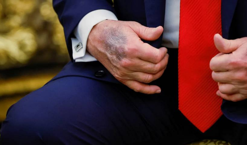 Trump’ın elindeki morluk dikkat çekti
